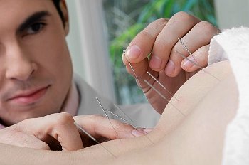 Acupuncturist inserts needle into patient's back