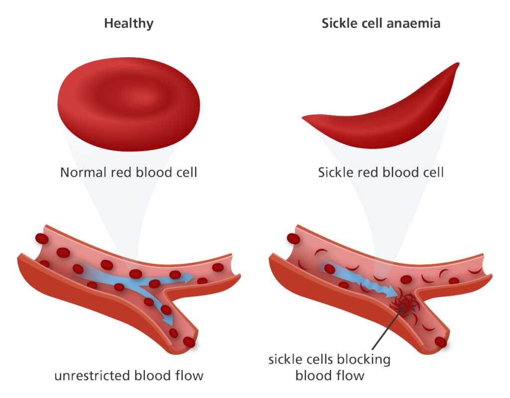 what-is-sickle-cell-anemia-modern-biology-inc