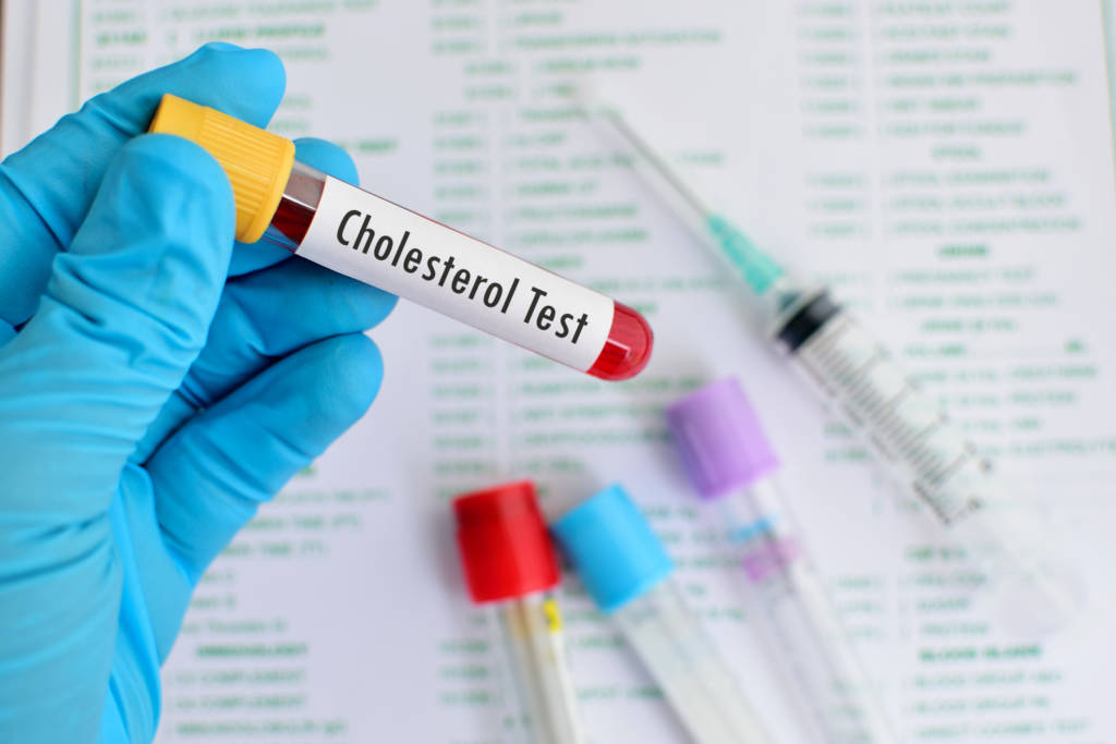 Cholesterol testing, cholesterol test, cholesterol test results