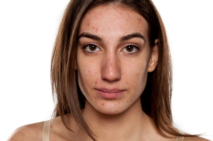 rosacea,problem skin, pimples
