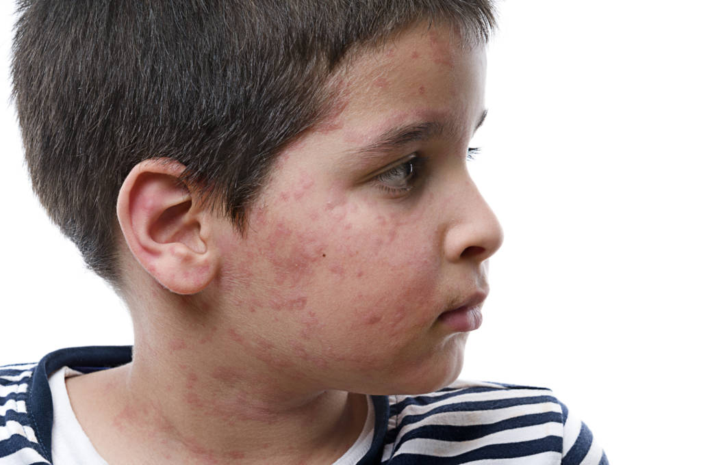 boy with allergy