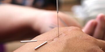 How Acupuncture Helps Lose Weight