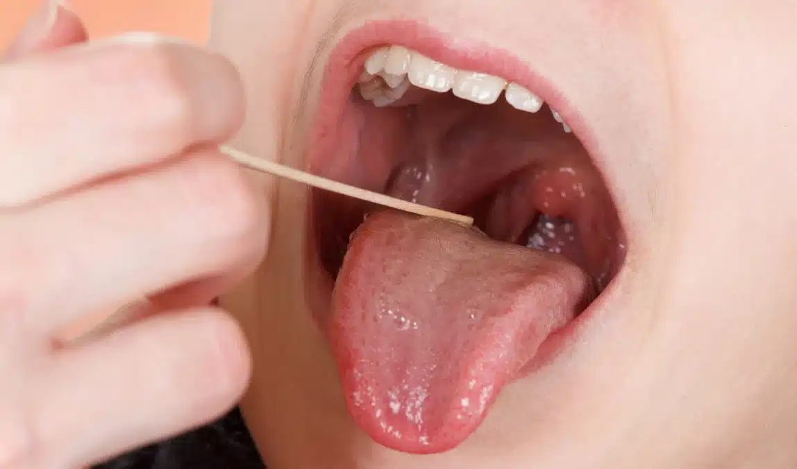 Cáncer oral en aumento entre personas con VIH: factores de riesgo que debes conocer
