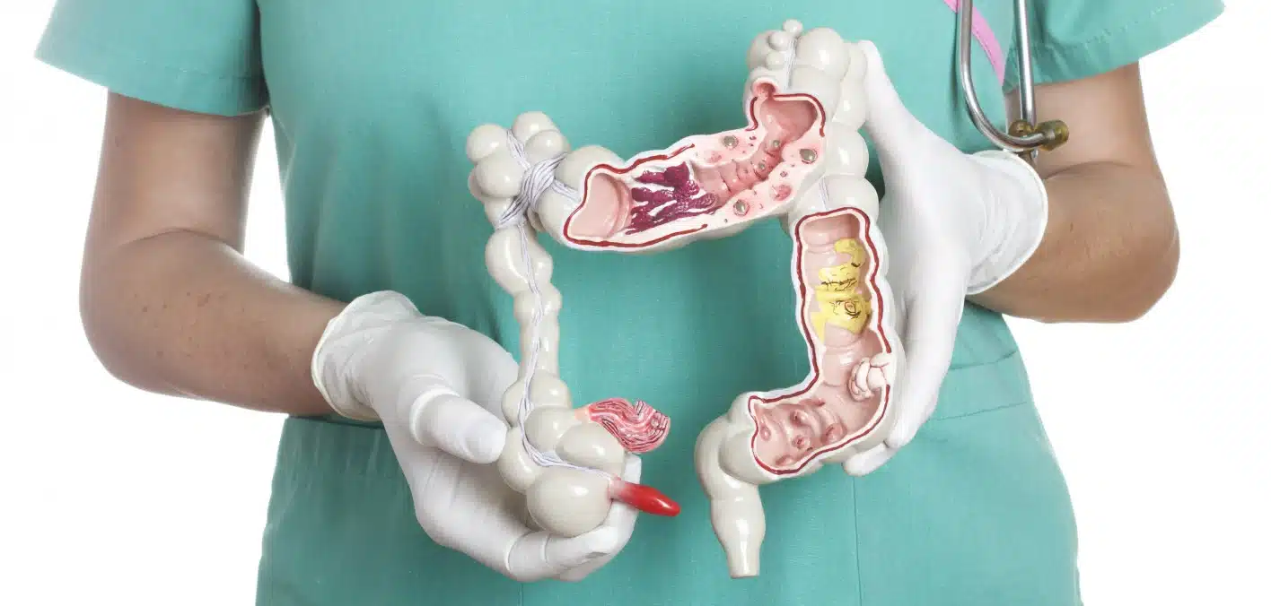 La Sociedad Americana del Cáncer Actualiza las Guías de Detección del Cáncer Colorrectal
